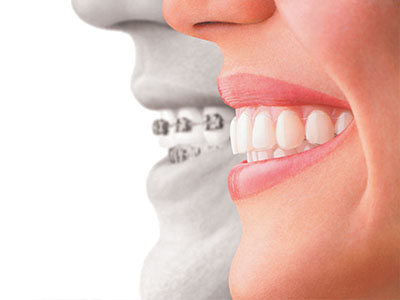 Darryl Lieberman, DDS Associates | Veneers, Preventative Program and Dental Cleanings